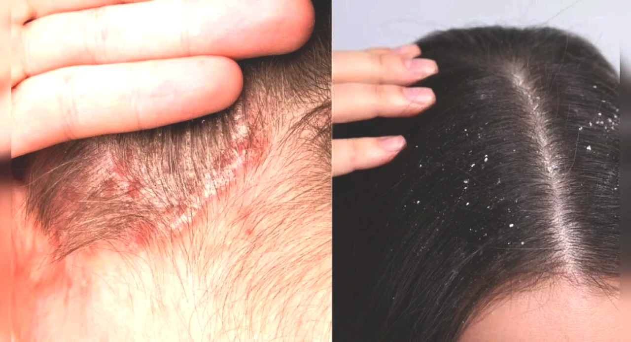 Keşfedin: Kepek mi, Saç Derisi Psoriyazisi mi? Belirtiler, Nedenler ve Etkili Yönetim Taktikleri!